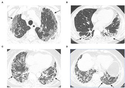 A New Predictive Model for the Prognosis of MDA5+ DM-ILD